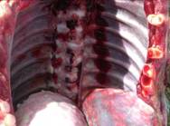 pleurisy Fibrin tag2