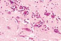 Water salt posionoing eosinophilia meningeoencephalitis spb