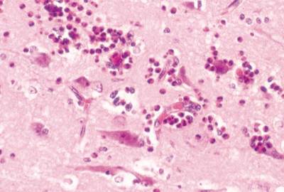 Water salt posionoing eosinophilia meningeoencephalitis spb