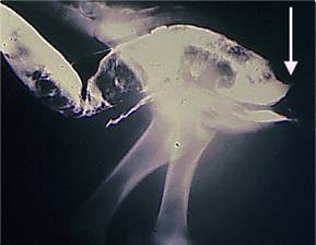 rectalstricturearrow2