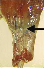 Rectal sticture PM inside of rectum