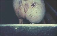 Legs hip abscess