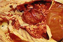 Thrombocytopaenia