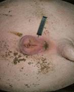 medicine vulval inject