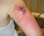 Erysipelas man Cellulitis_1_030302.jpg