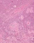 PCVII lymphnode